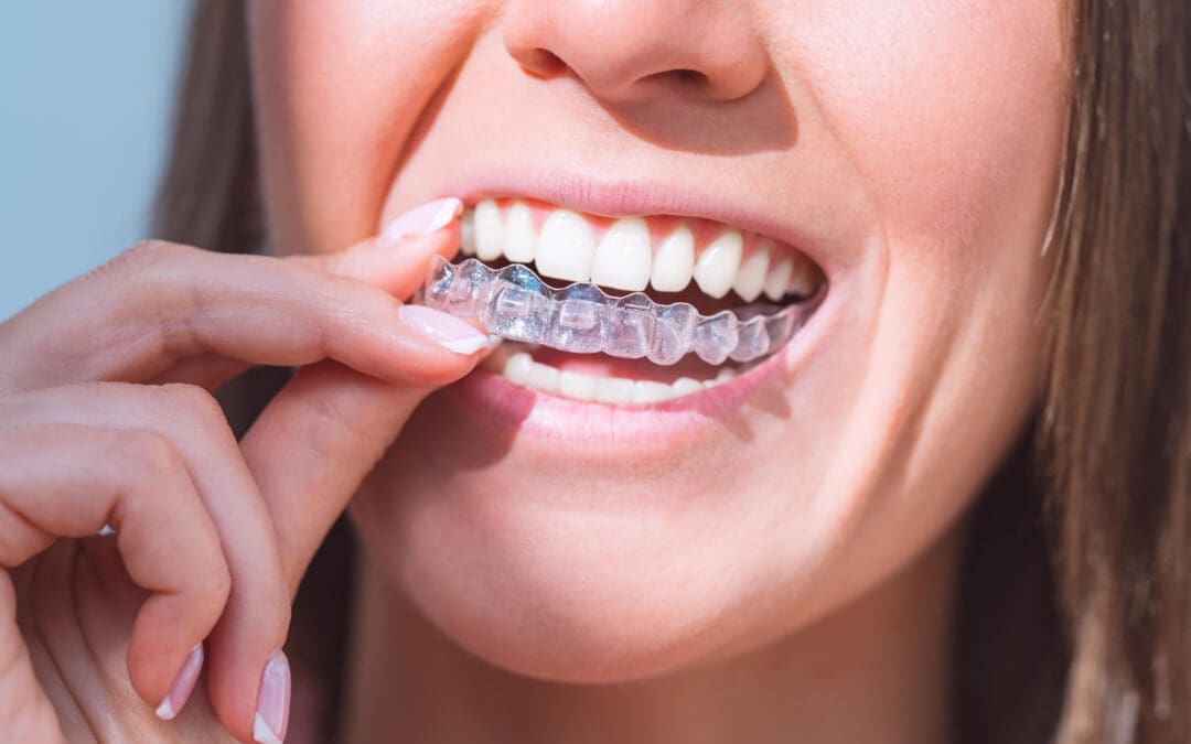 Affordable Clear Aligners: Straighten Teeth on a Budget